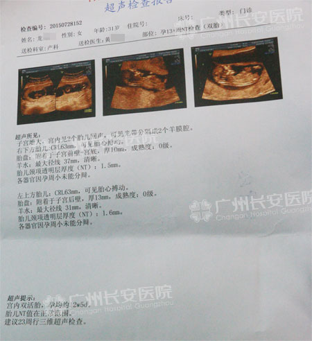 【81317例报喜】奇迹在身边：垂体性闭经患者怀双胞胎