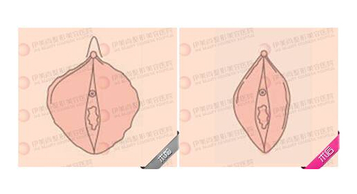 阴道松弛挂什么科?如何治疗?