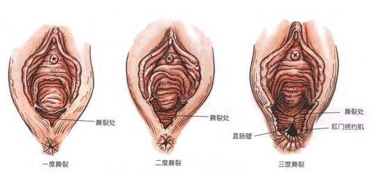 会阴裂伤原因?症状有哪些?怎么治疗?