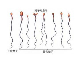 少精症患者需要做哪些检查？