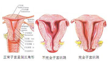 子宫纵膈是怎么回事