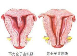 子宫不完全纵膈是什么