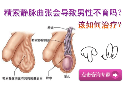 左侧精索静脉曲张怎么治疗