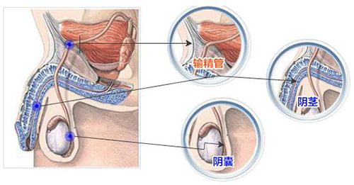 男人输精管堵塞怎么回事?能治好吗?