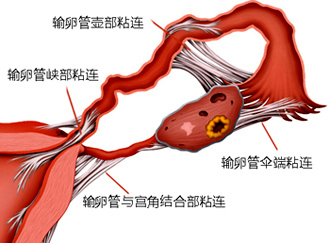 输卵管粘连怎么检查？