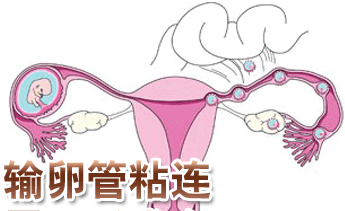 如何诊断输卵管粘连
