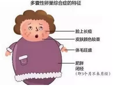 多囊卵巢综合症患者需要做些什么检查