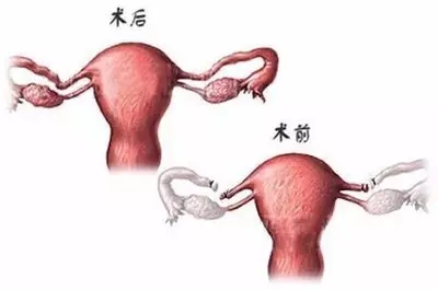 输卵管复通术