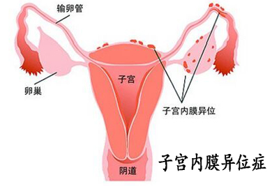 子宫内膜异位症癌变几率高吗